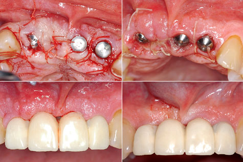 osteointgration des implants dentaires