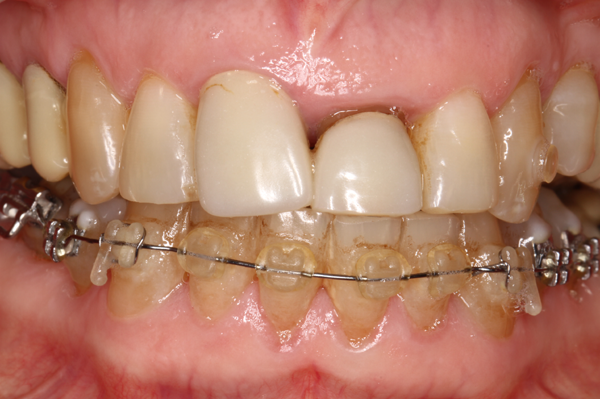 traction orthodontique