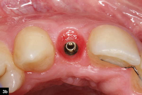 augmentation latérale implant dentaire