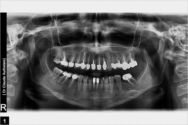 Pano et coupe, fracture en diagonale du tiers cervical de la racine de la dent n° 22,