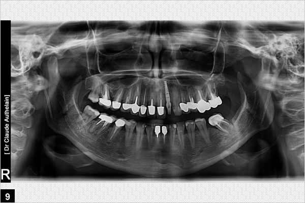 implant dentaire en place