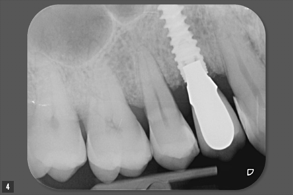 radio implant dentaire posé