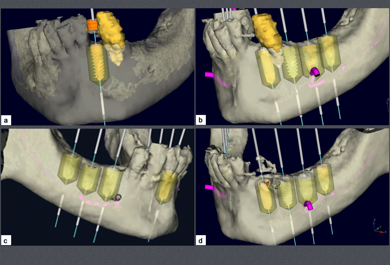 simulation de la pose de l'implant dentaire