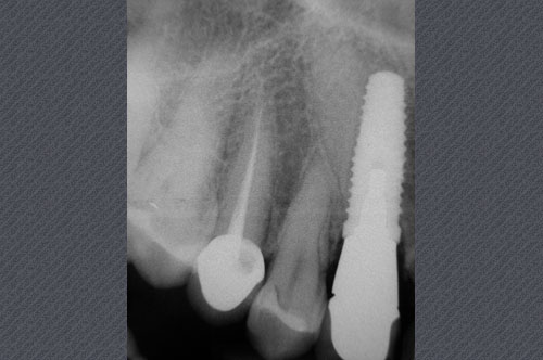 tissu osseux ayant comblé l'espace vide autour de la dent