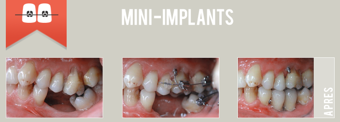 mini implants