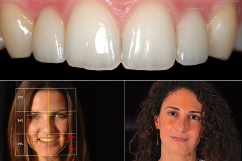 esthétique dentaire, implants