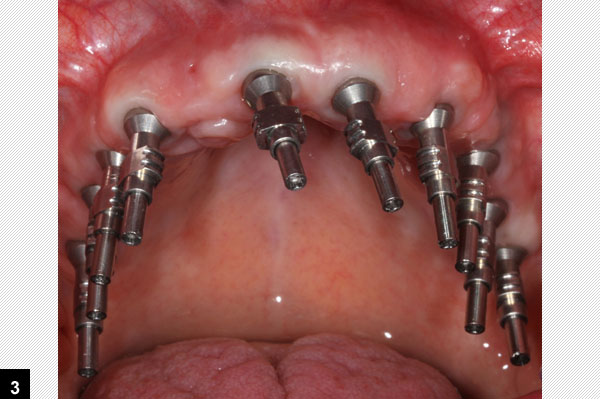 empreinte en plâtre, 8 implants dentaires