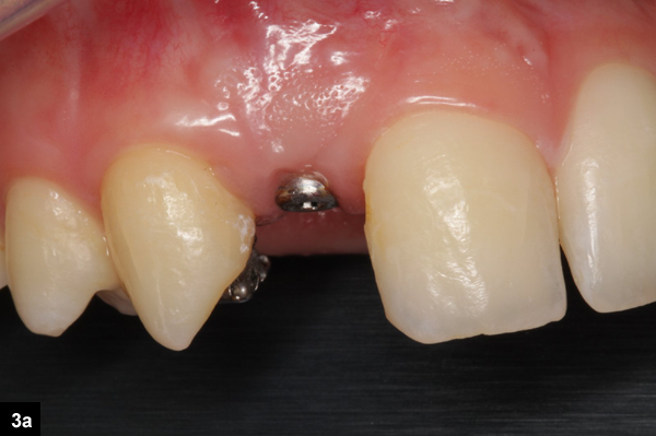 augmentation latrale implant dentaire