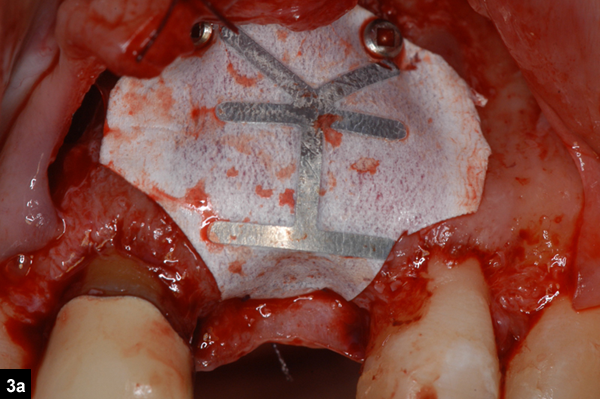 membrane fixe en palatin par une suture