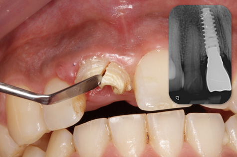 fracture incisive implant dentaire