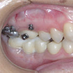 Ingression dentaire - Implantologie. EID Paris