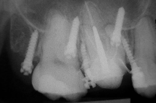 radiographie postopératoire des implants