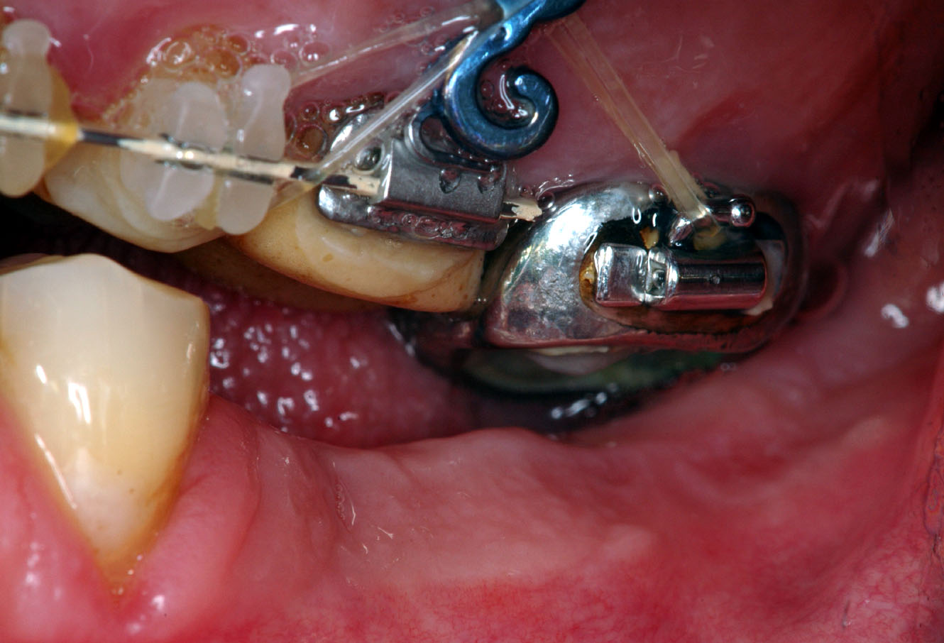 Traitement orthodontique