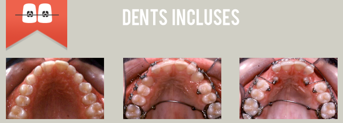 dents incluses